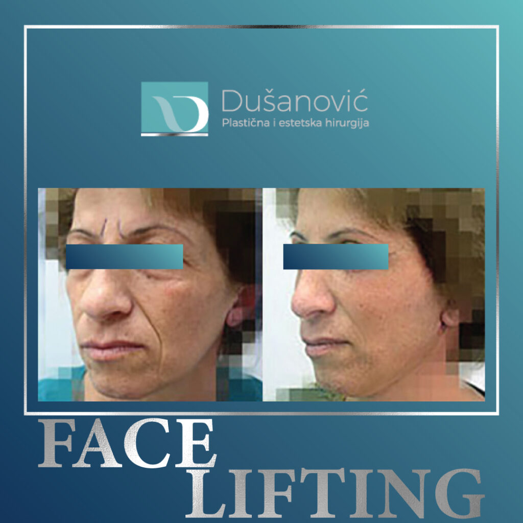 face lifting