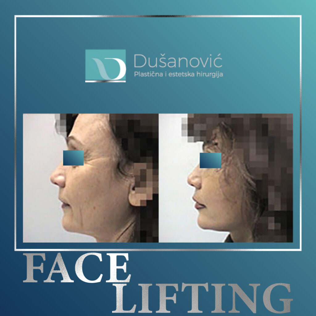 face lifting