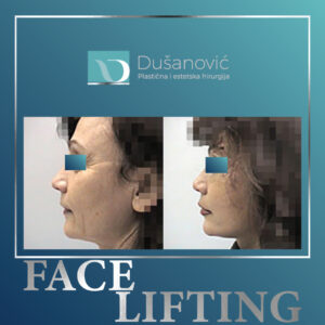 face lifting