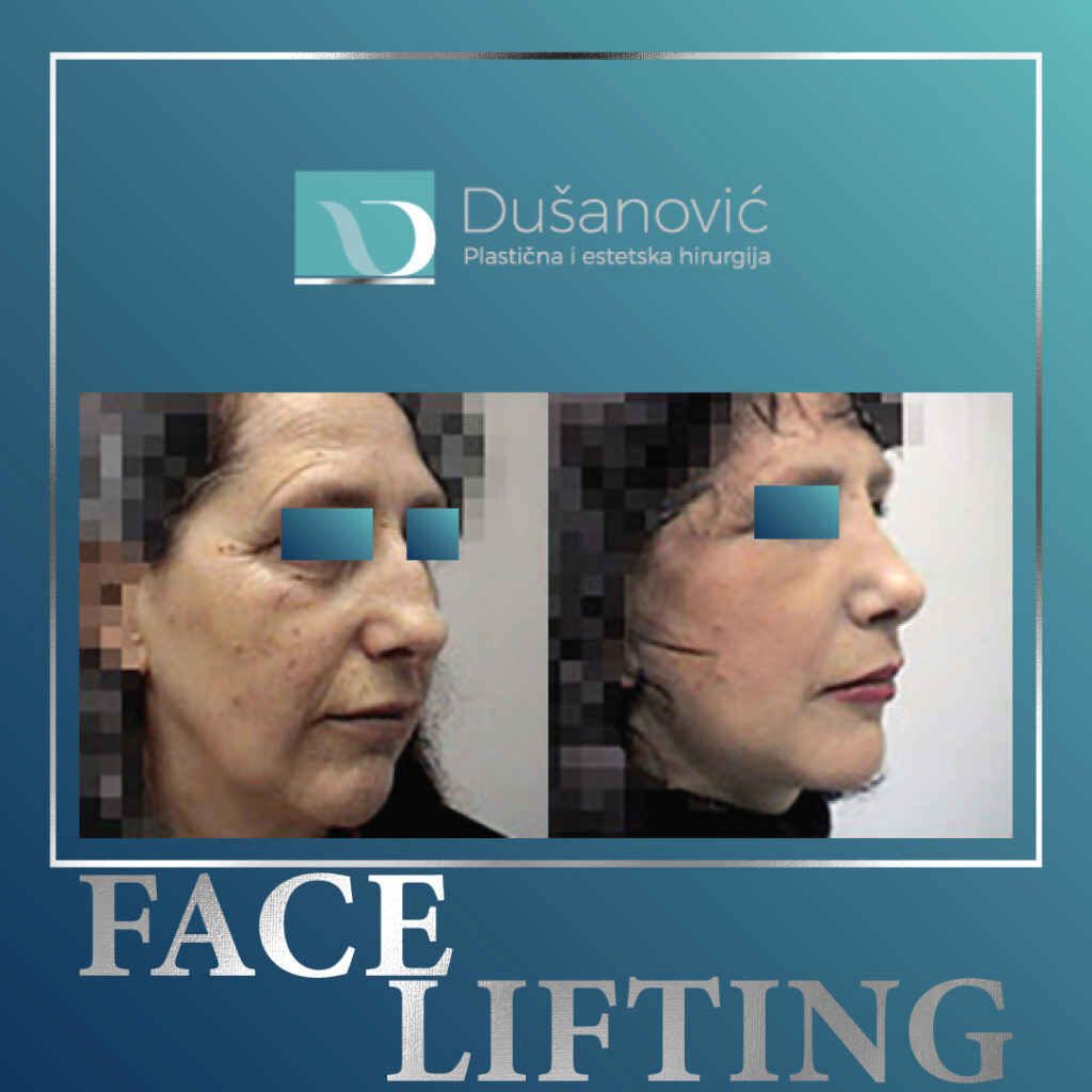 face lifting