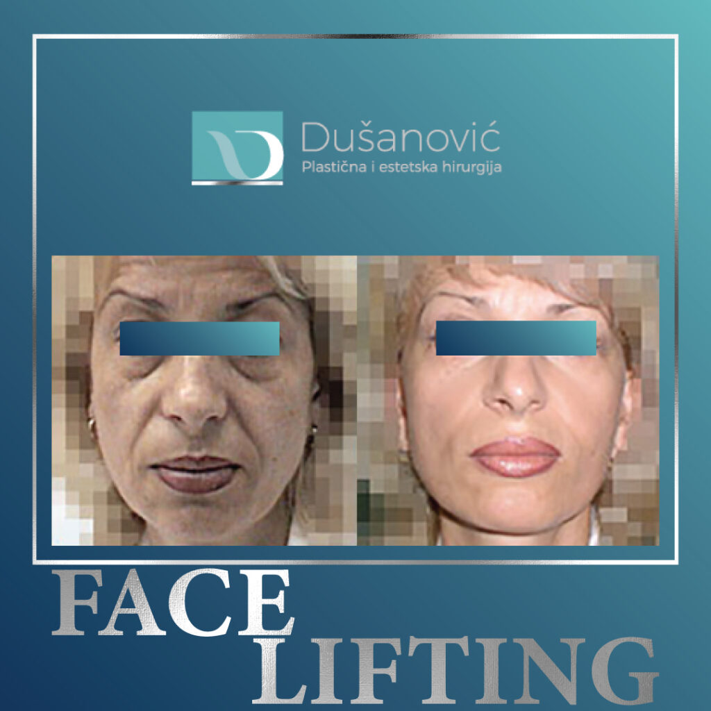 face lifting