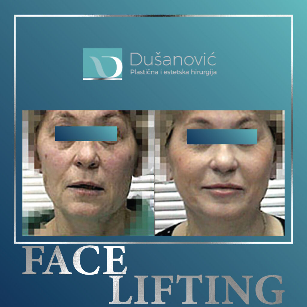 face lifting