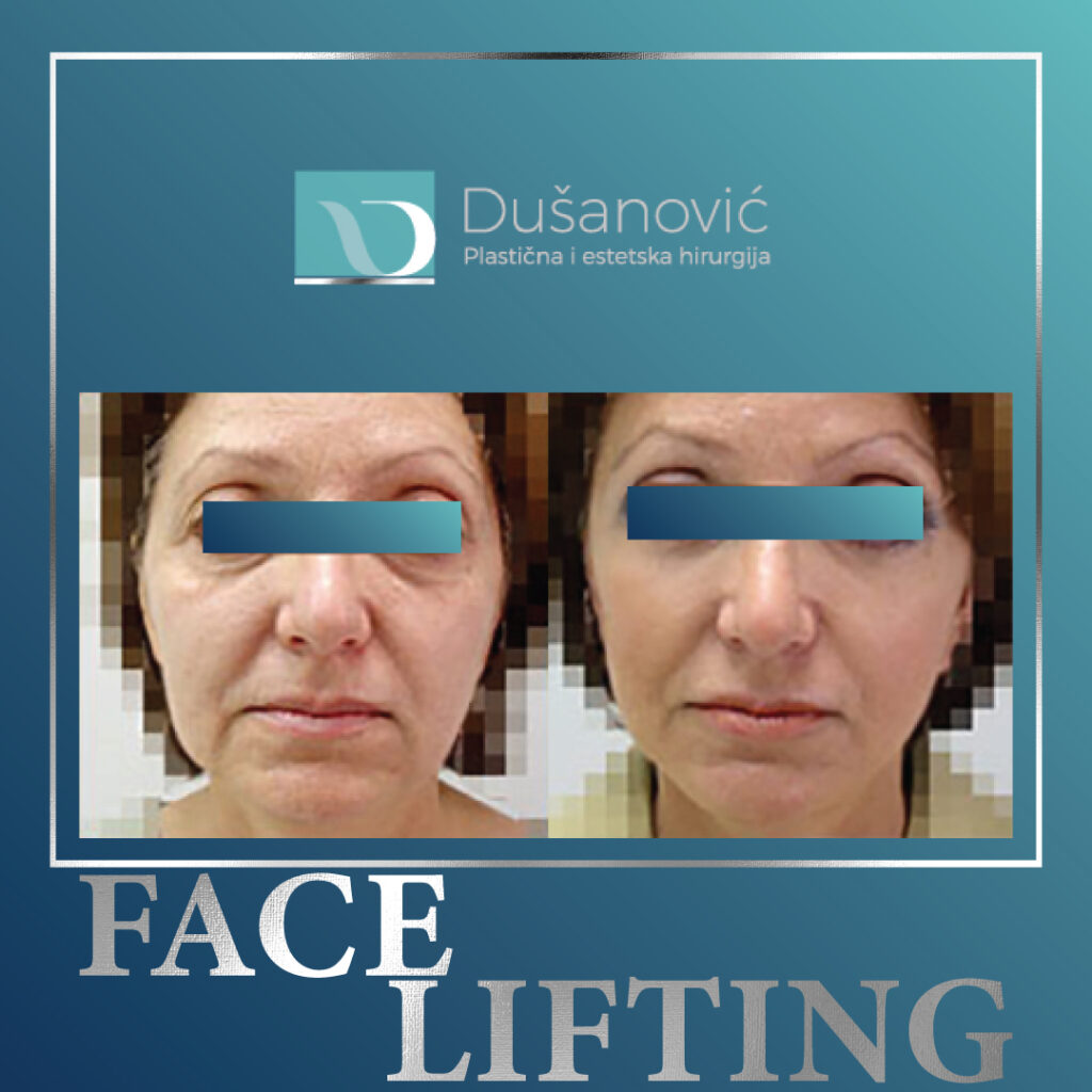 face lifting