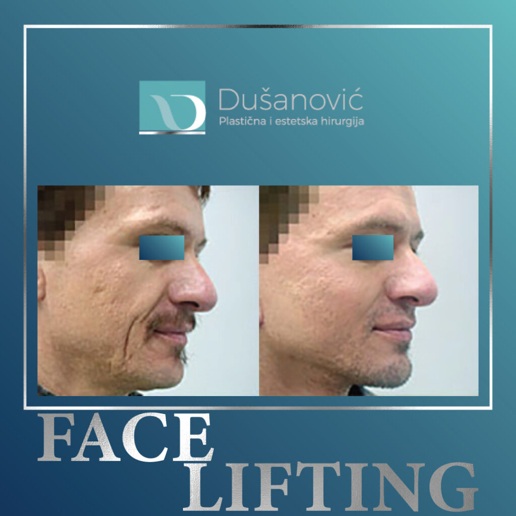 face lifting