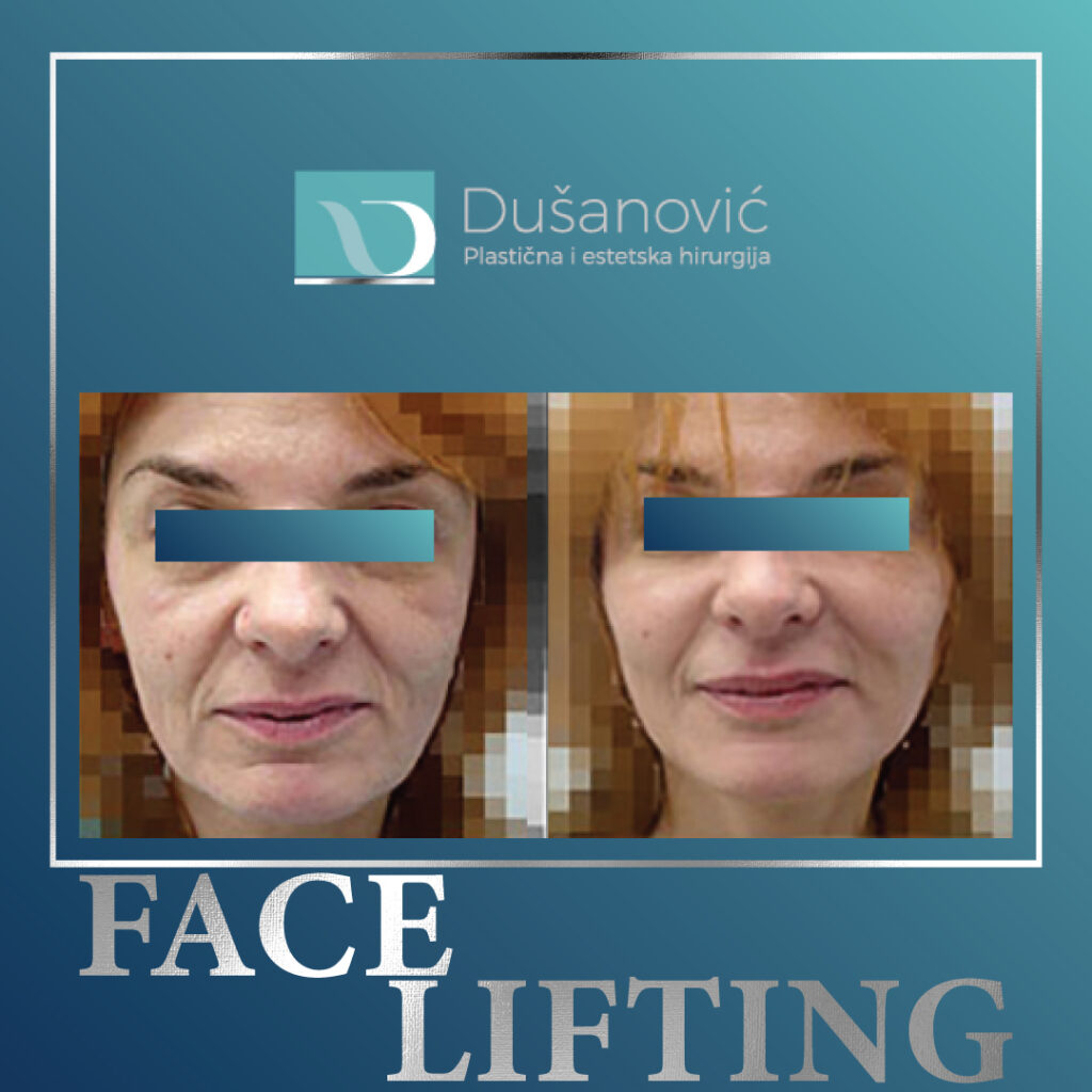 face lifting