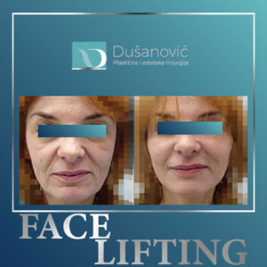 face lifting