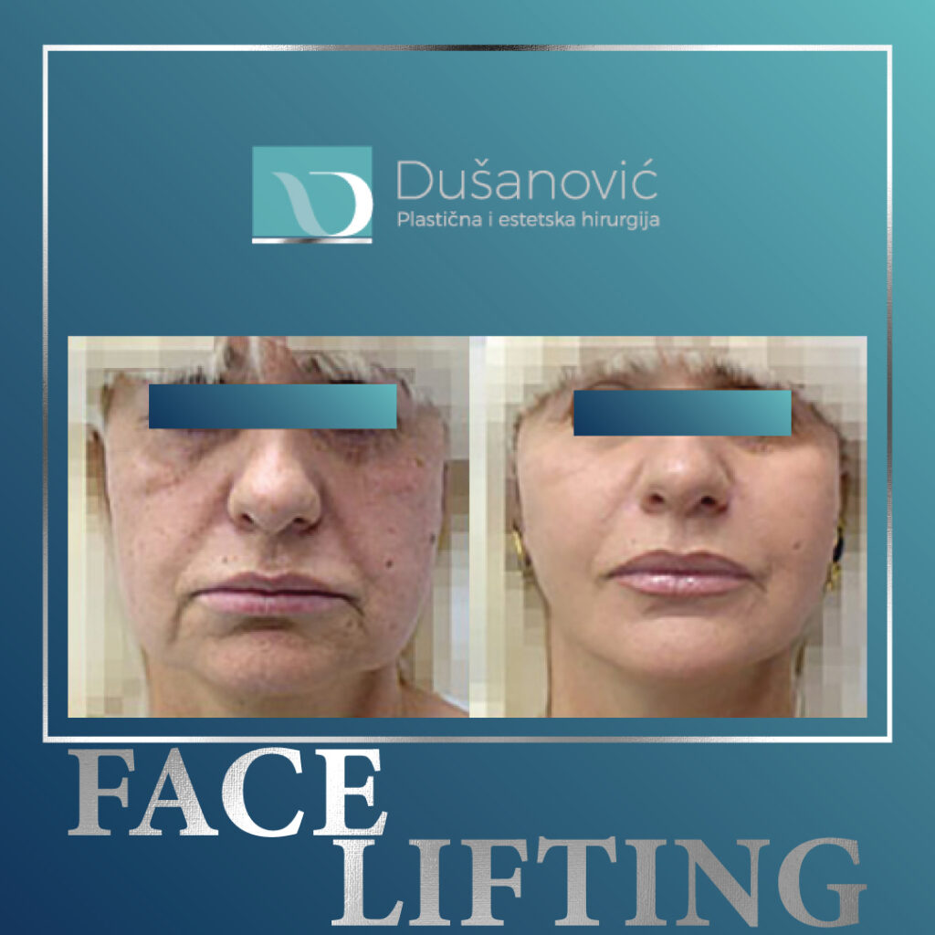 Face-lifting-17
