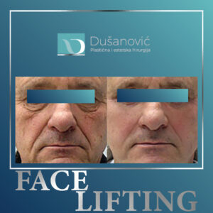 face lifting