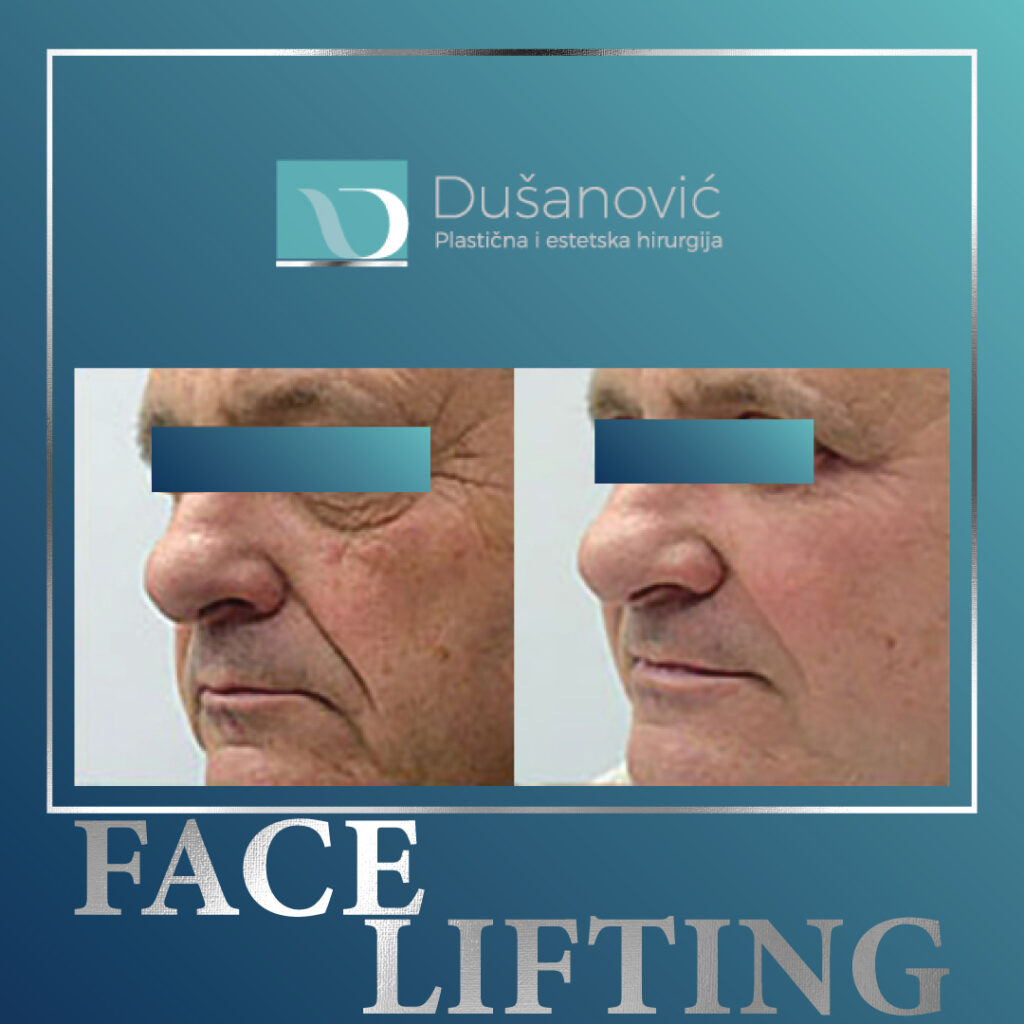 face lifting