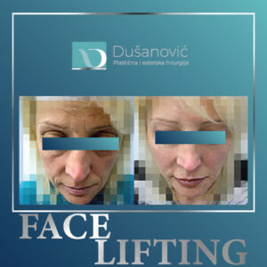 face lifting