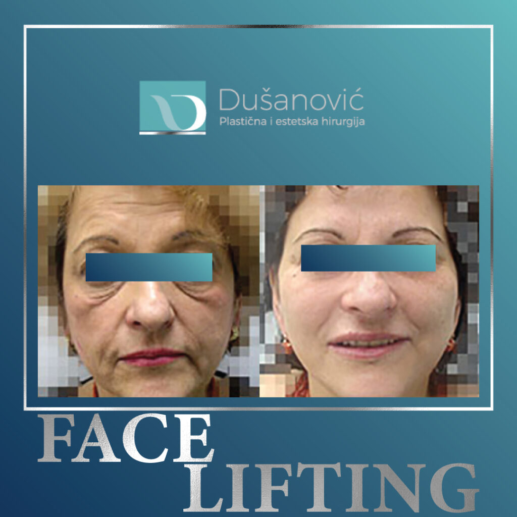 face lifting
