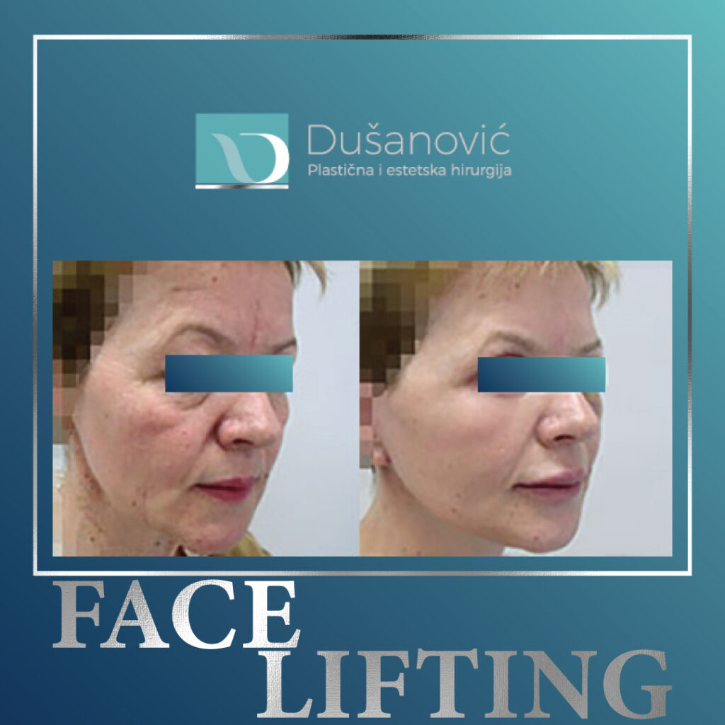face lifting