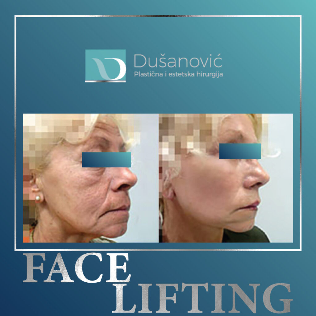 face lifting