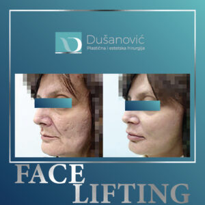 face lifting