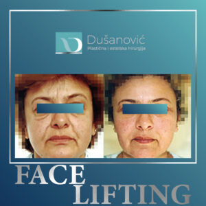 face lifting