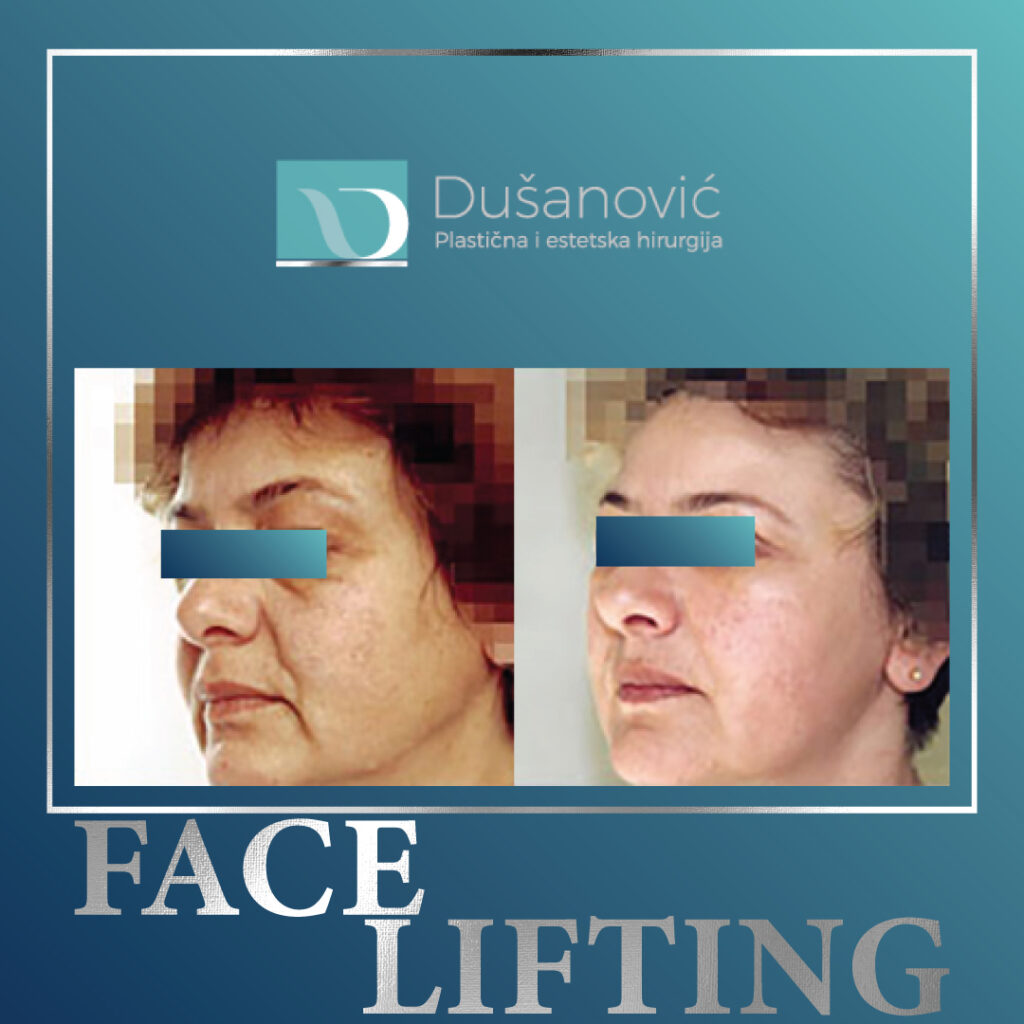 face lifting