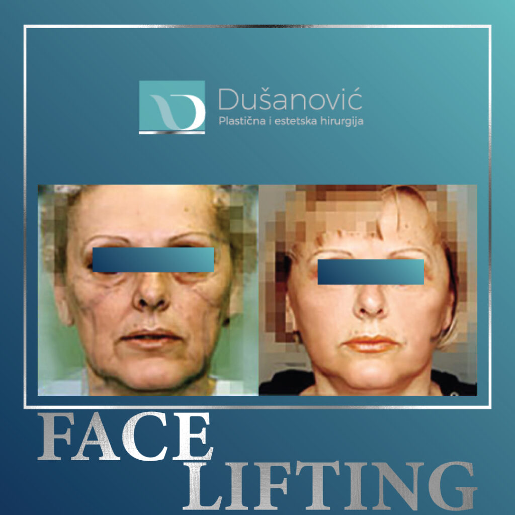 face lifting