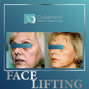 face lifting