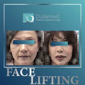 face lifting