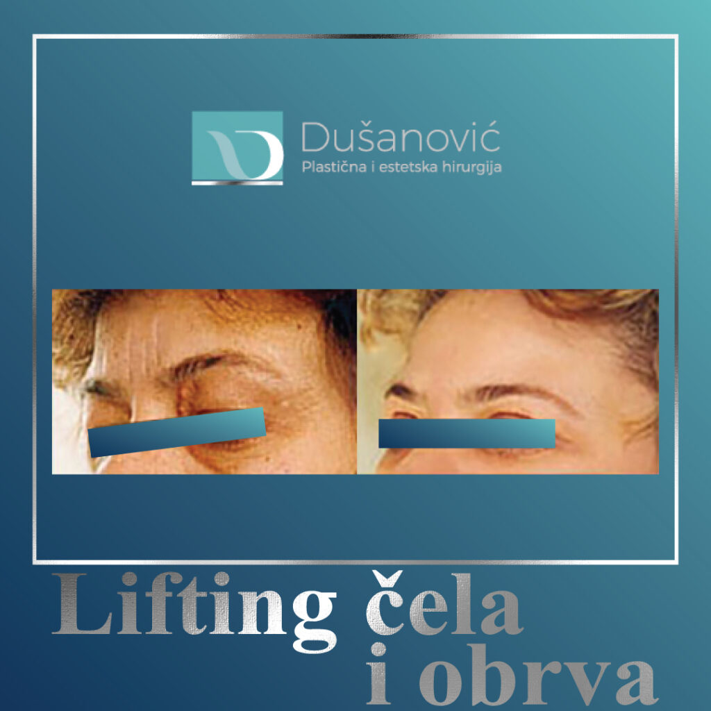 lifting cela i obrva