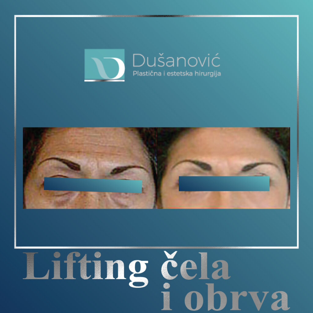 lifting cela i obrva