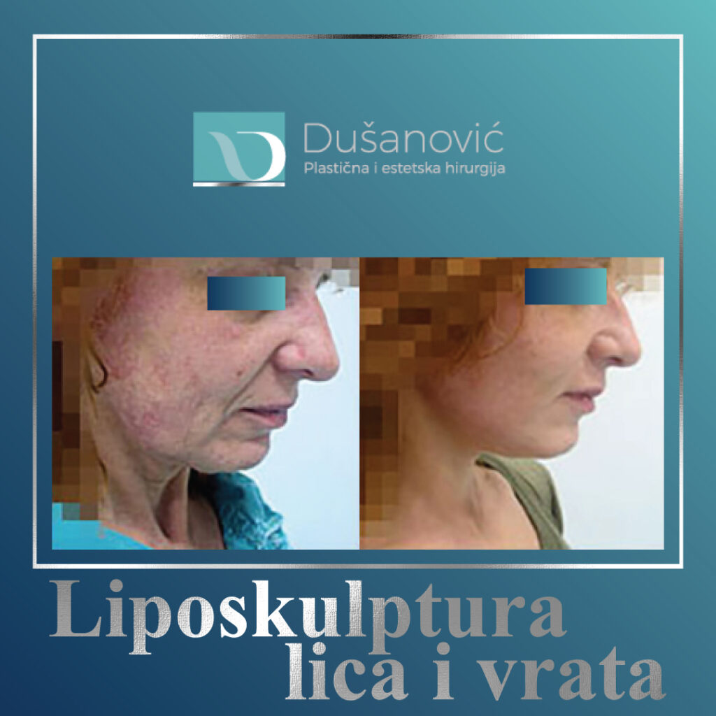 liposkulptura lica i vrata