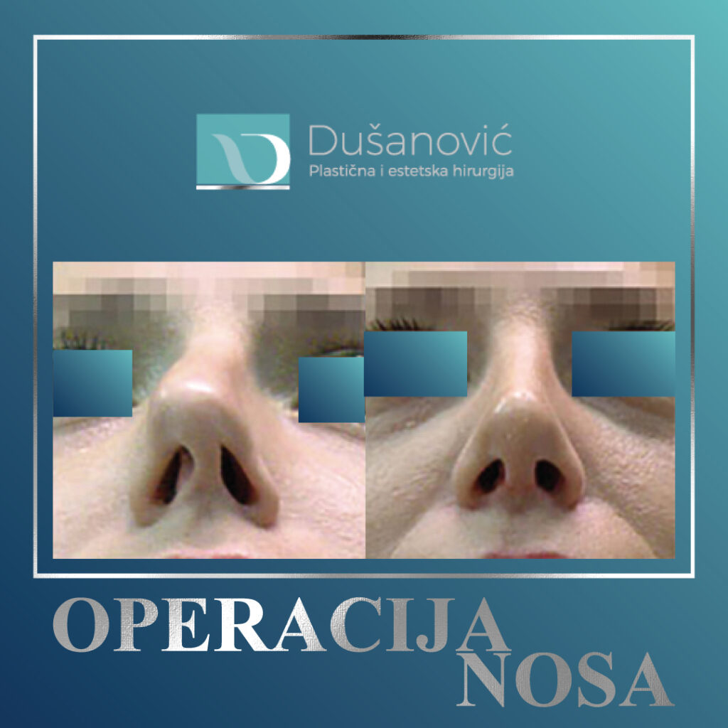 operacija nosa