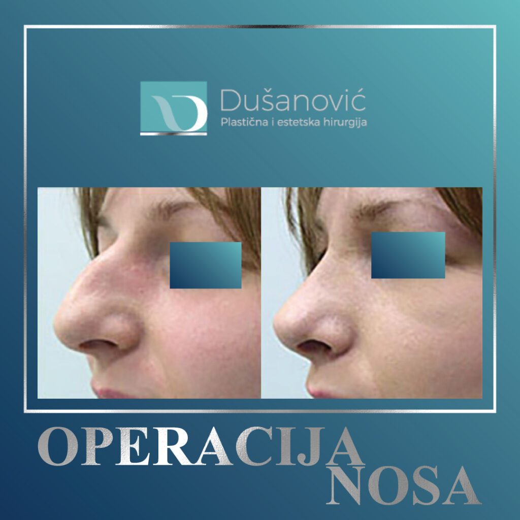 operacija nosa