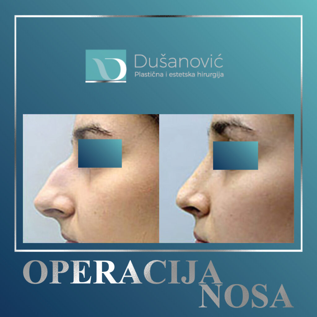 operacija nosa