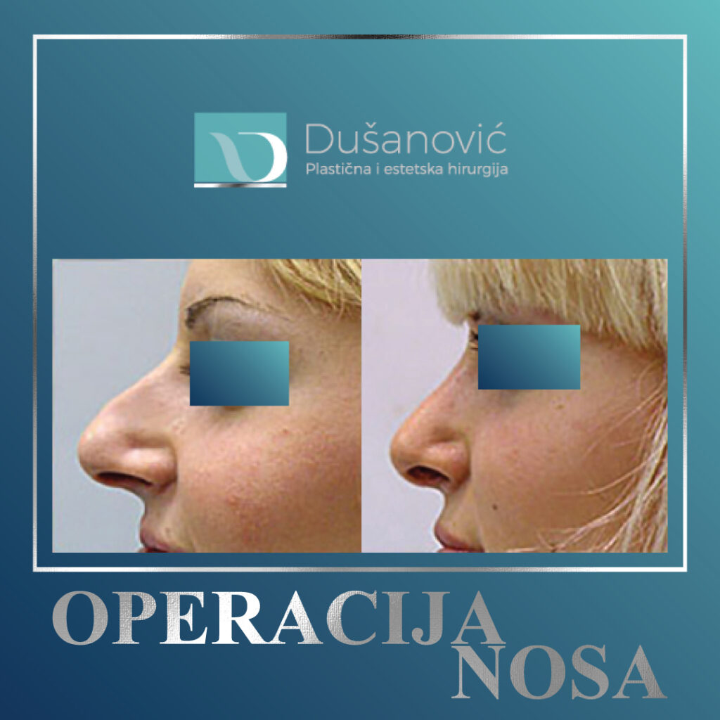 operacija nosa