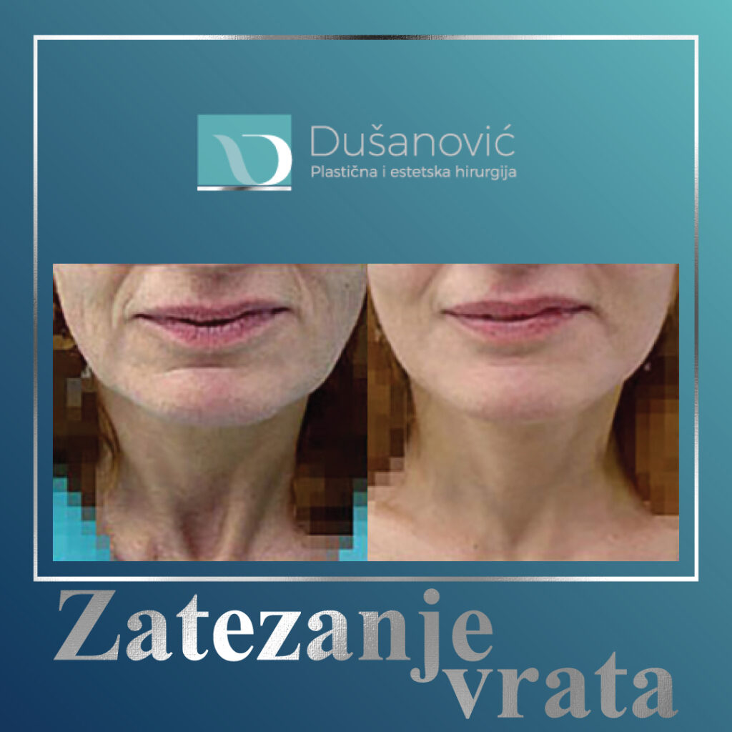 zatezanje vrata
