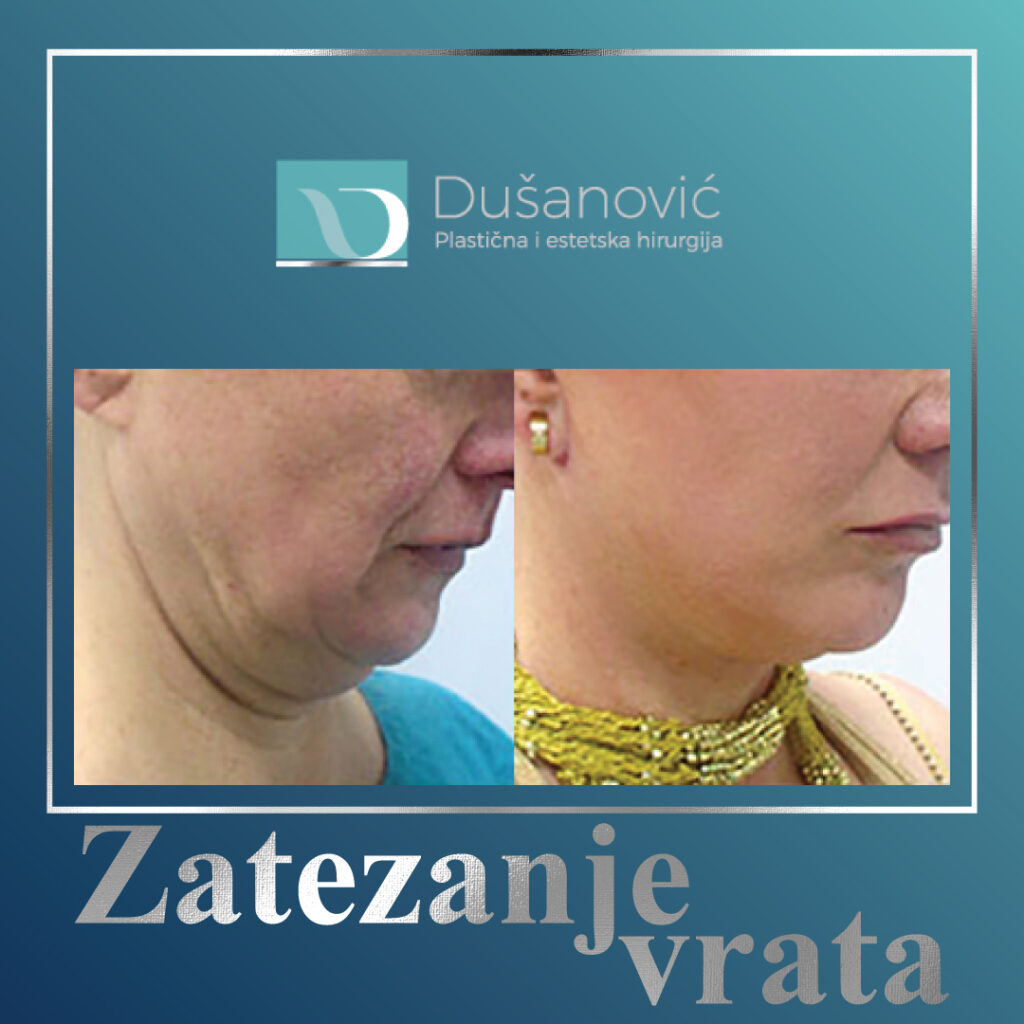 zatezanje vrata
