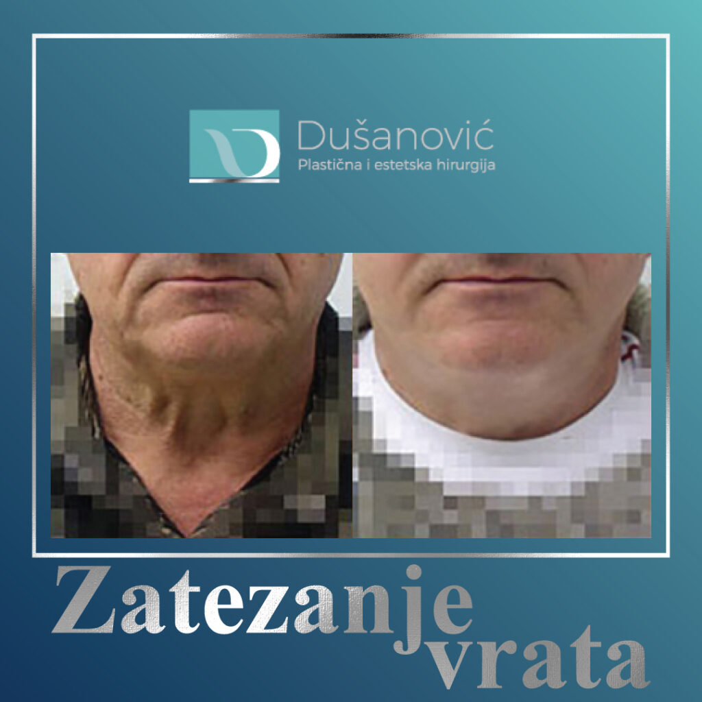 zatezanje vrata