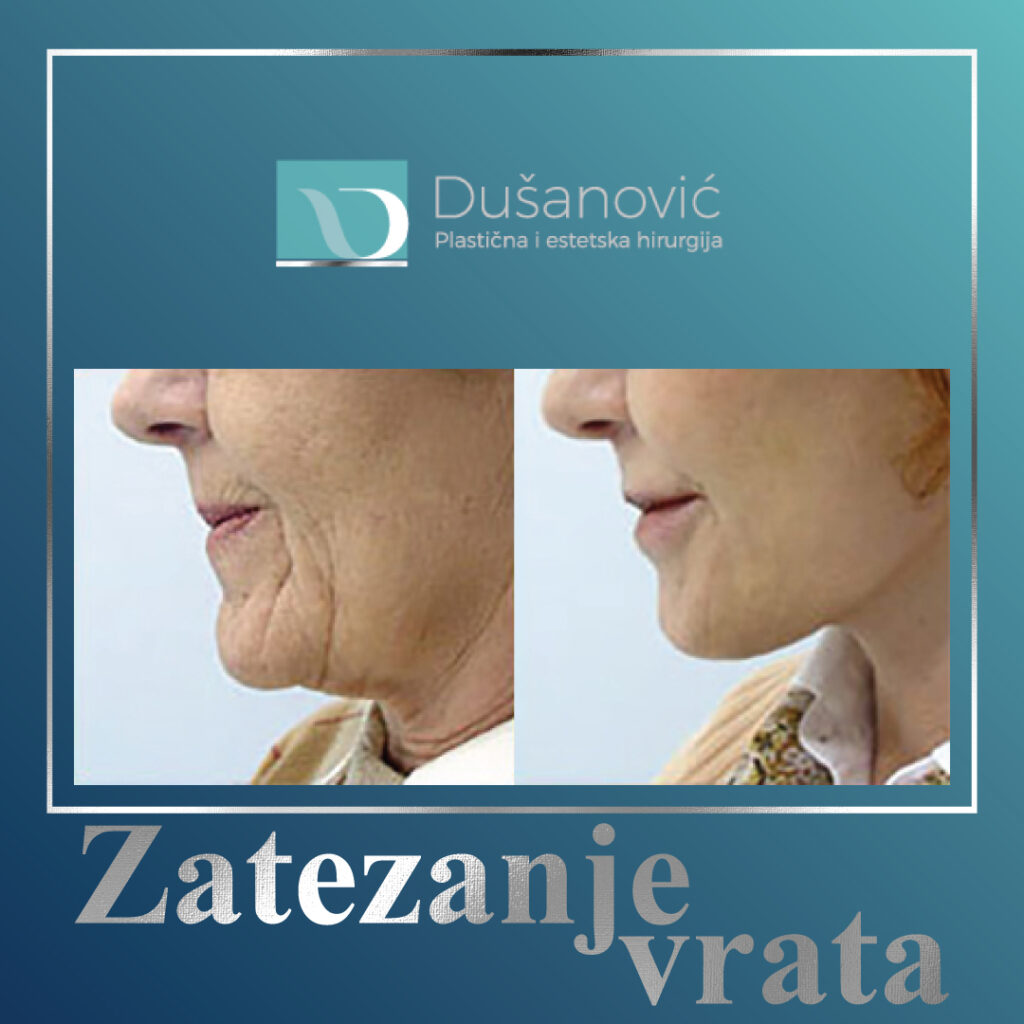 zatezanje vrata