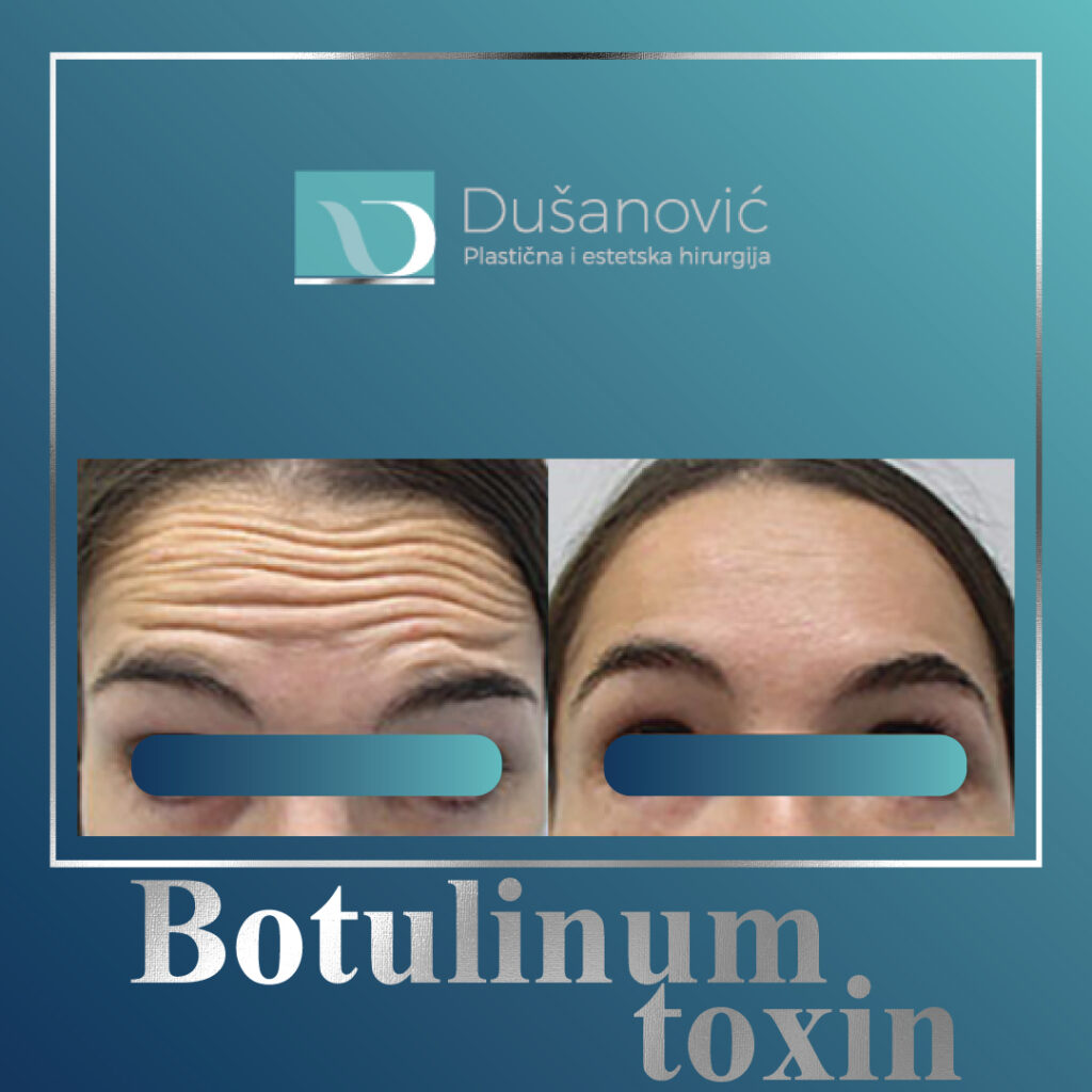 botulinum toxin, botox
