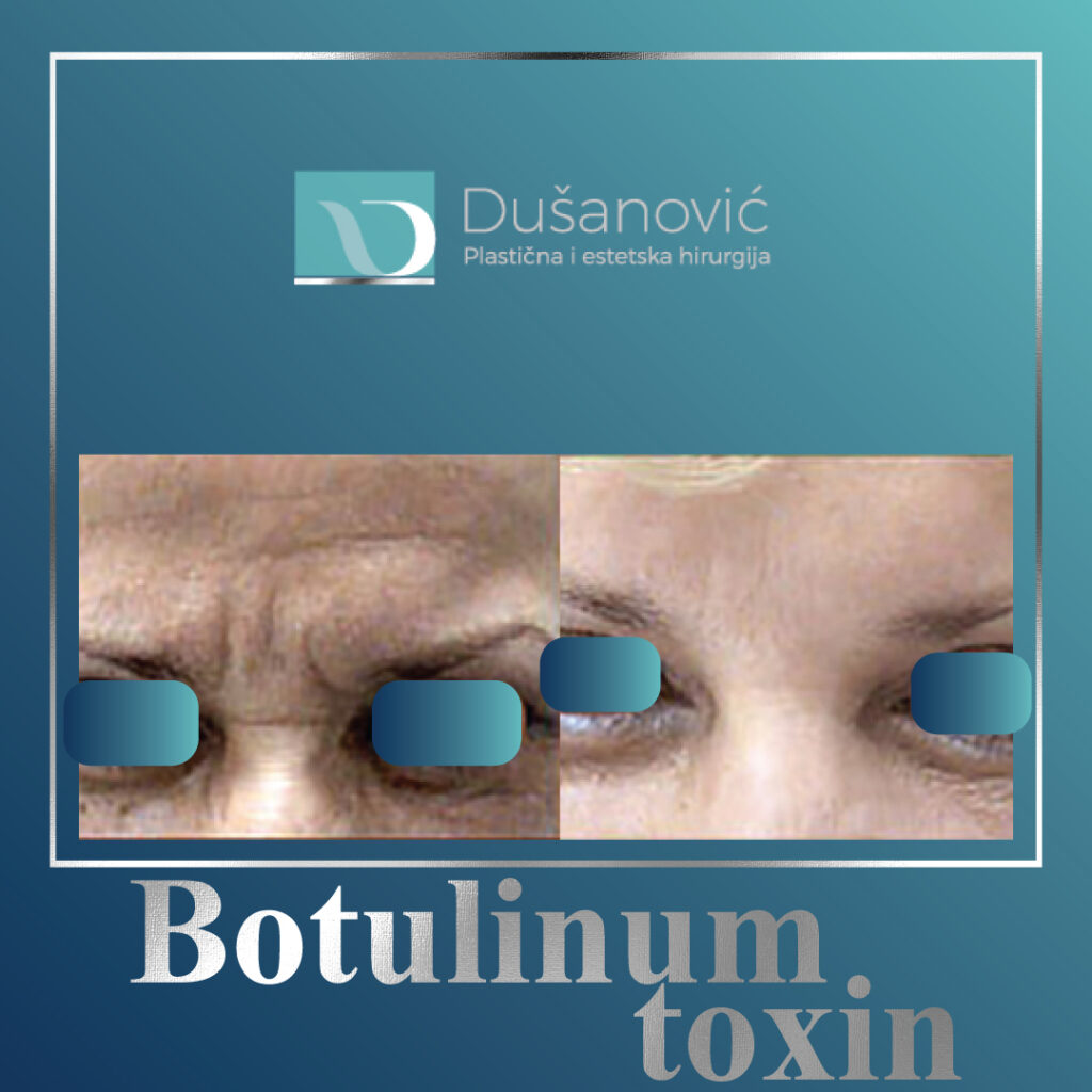 botulinum toxin, botox