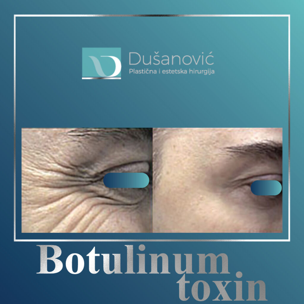botulinum toxin, botox