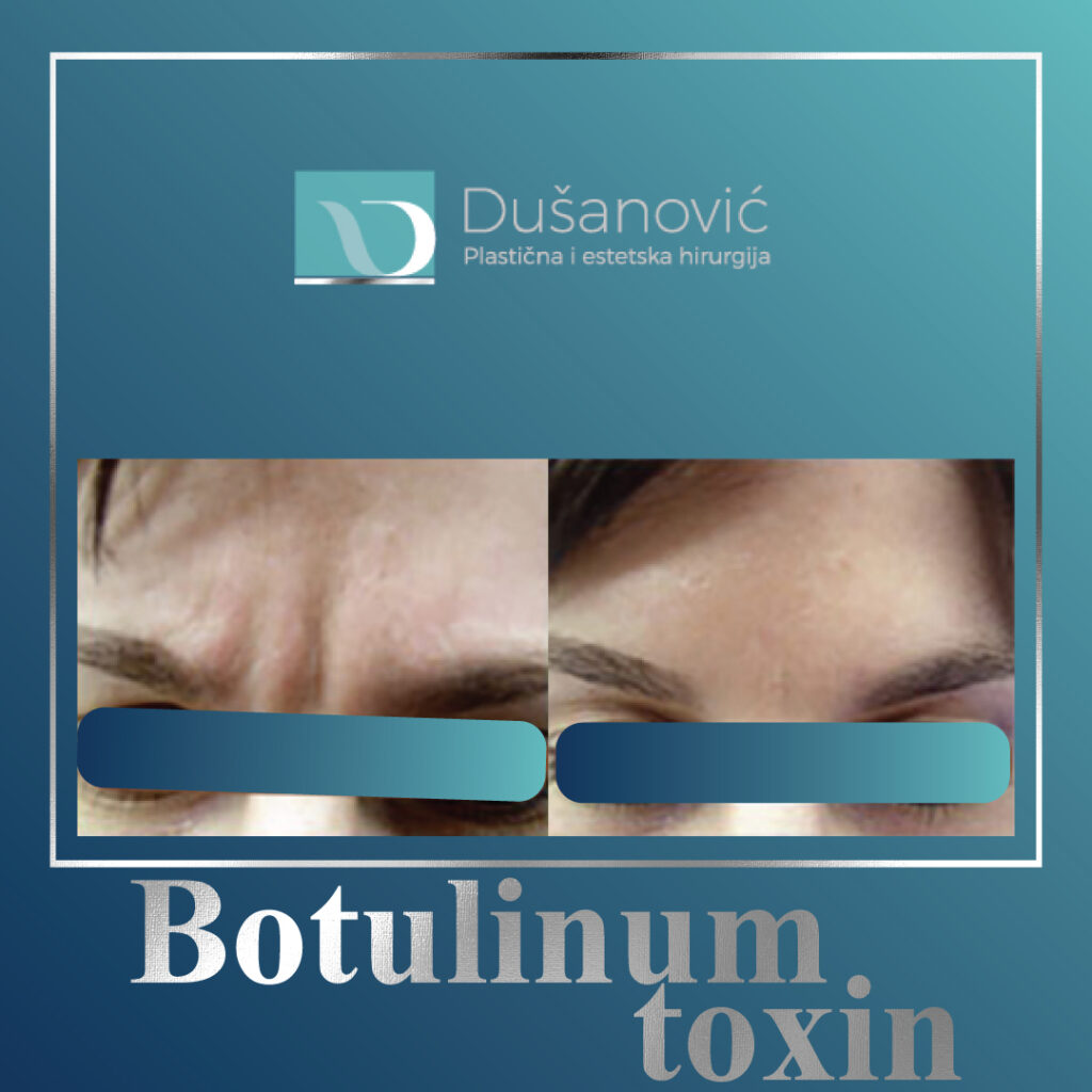 botulinum toxin, botox