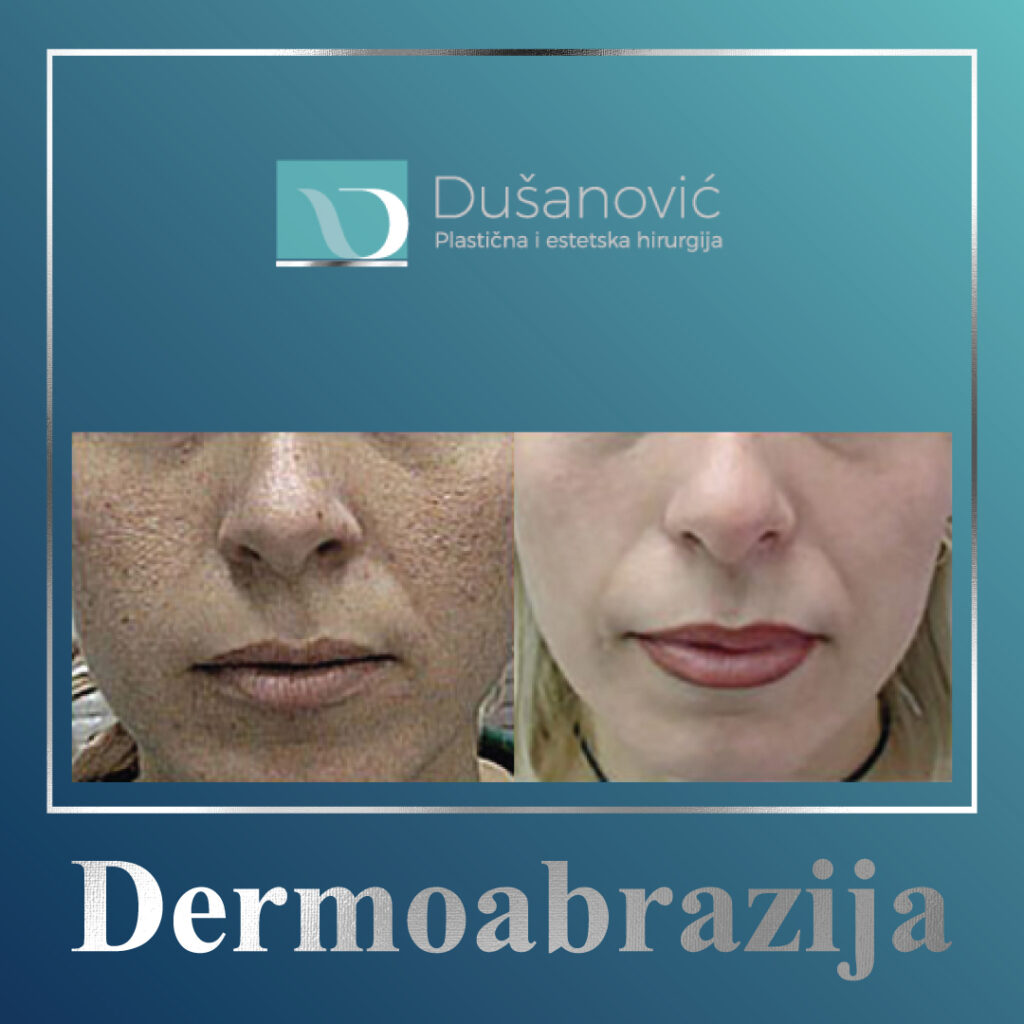 dermoabrazija