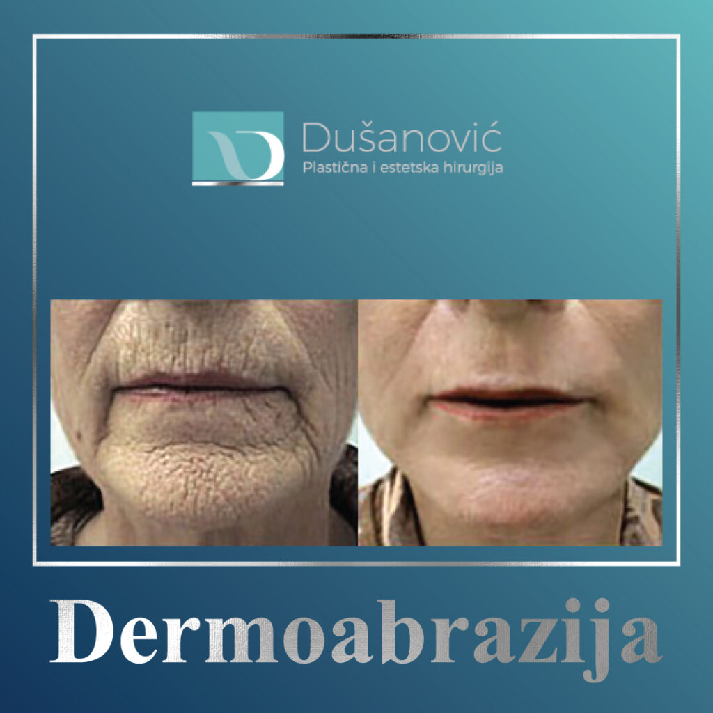 dermoabrazija