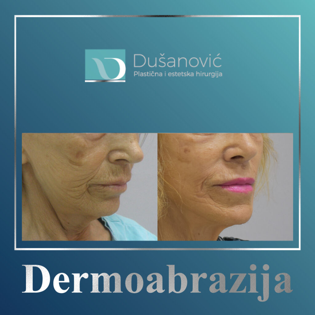 Dermoabrazija