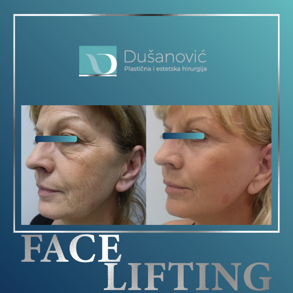 face lifting, zatezanje lica