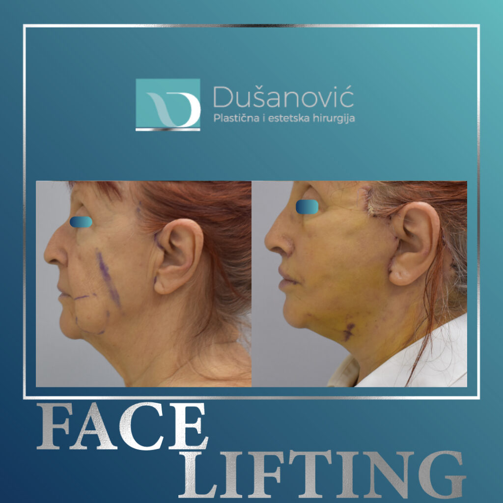 face lifting, zatezanje lica