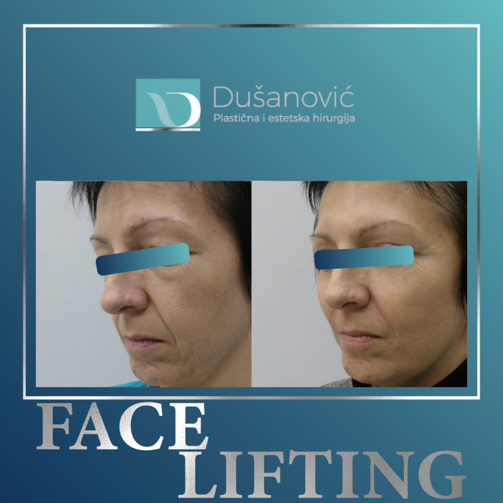 face lifting