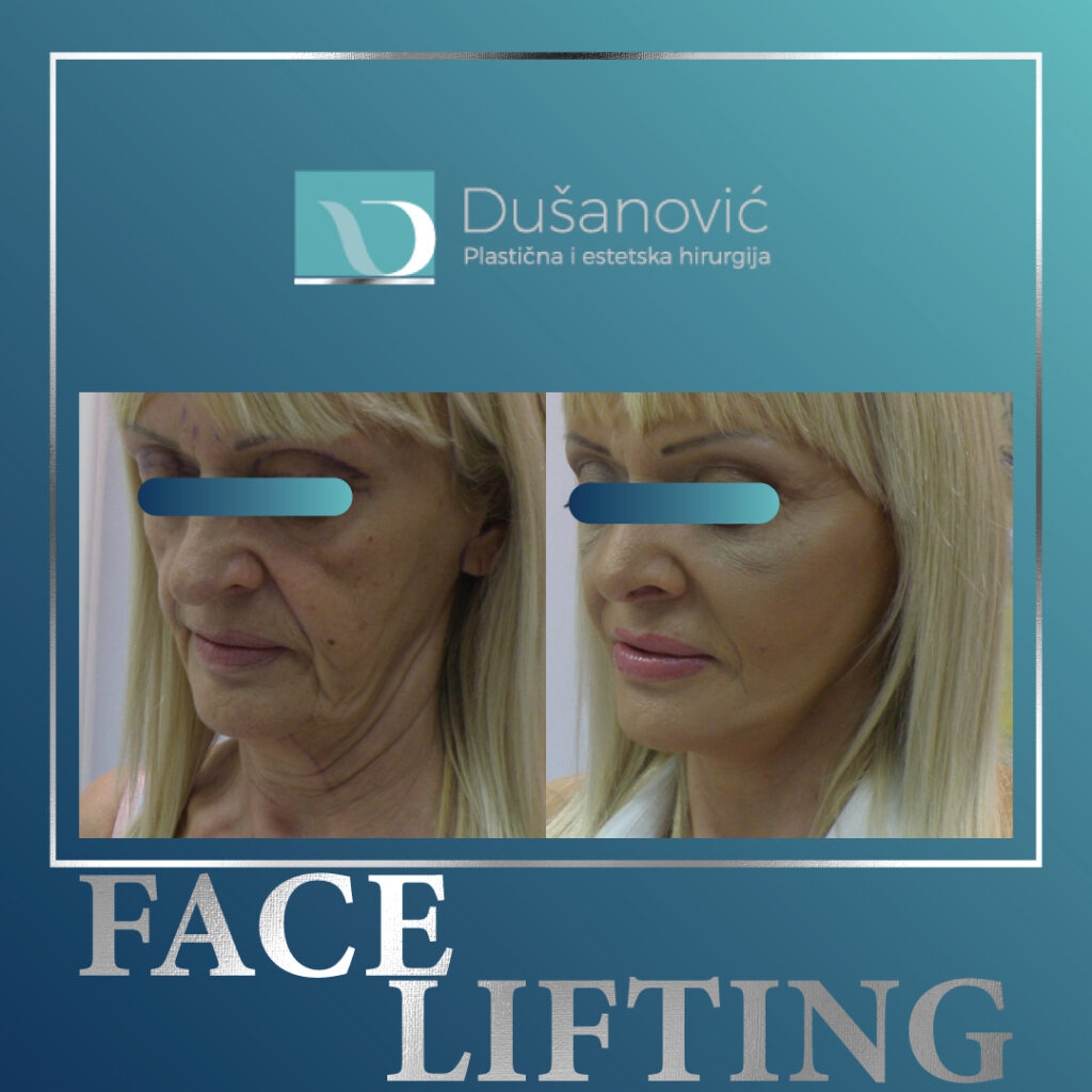 face lifting, zatezanje lica