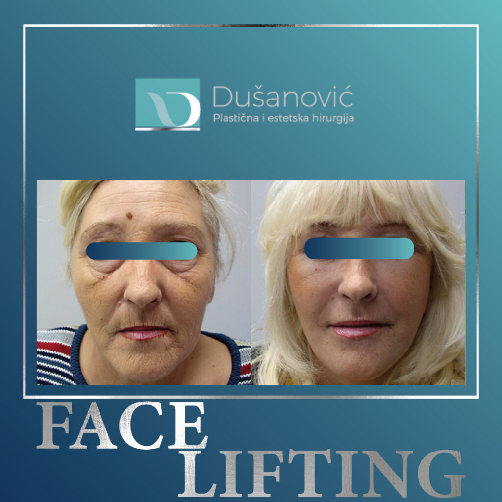 face lifting, zatezanje lica