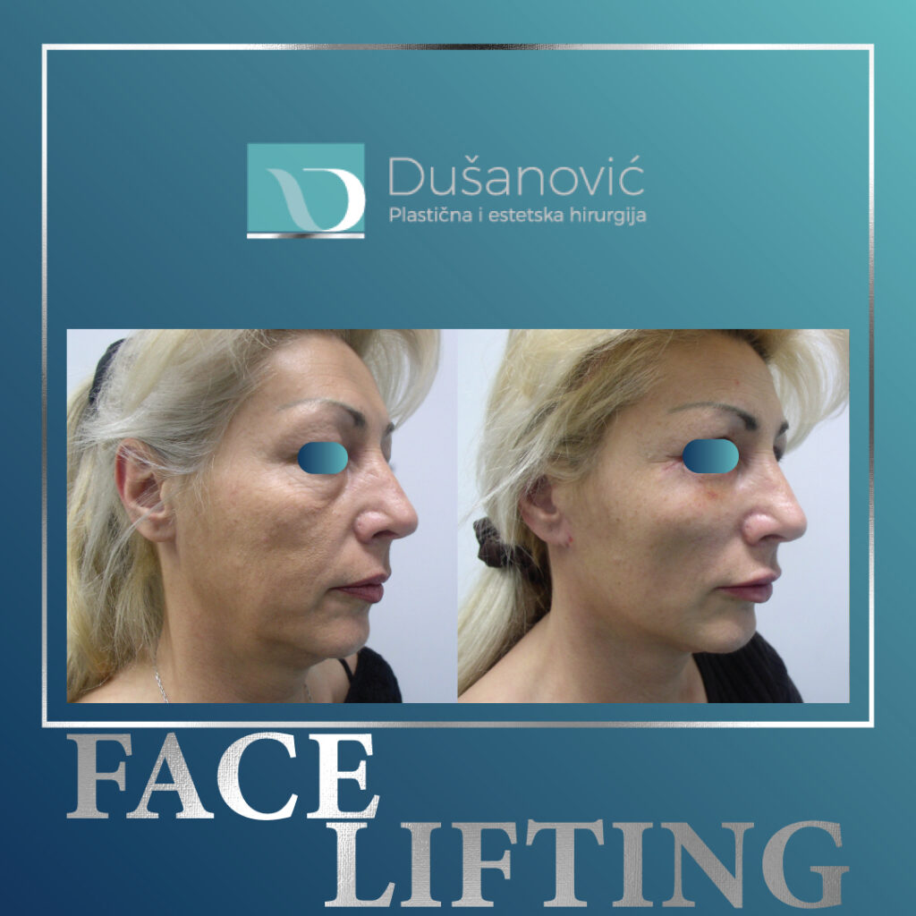 face lifting, zatezanje lica