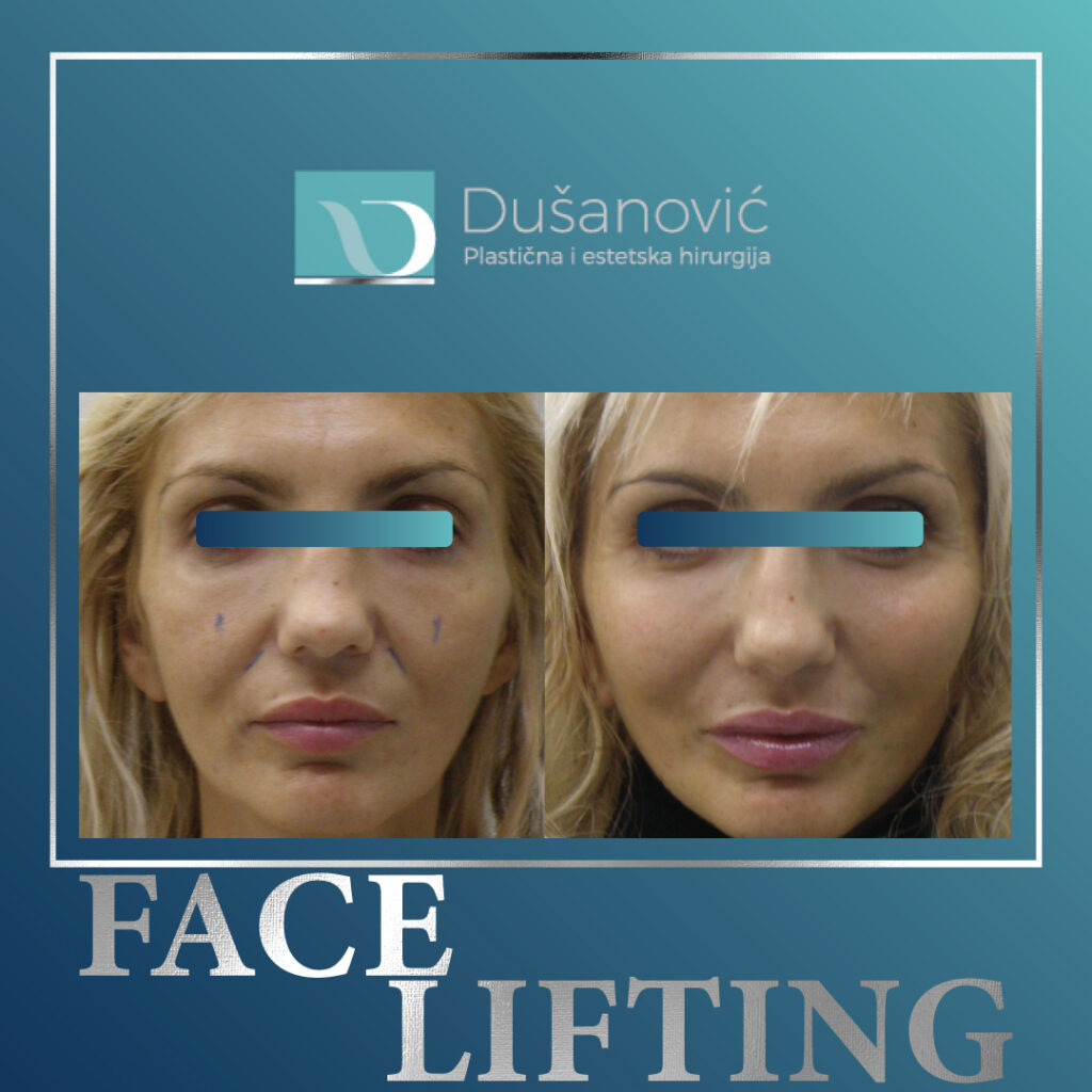 face lifting, zatezanje lica