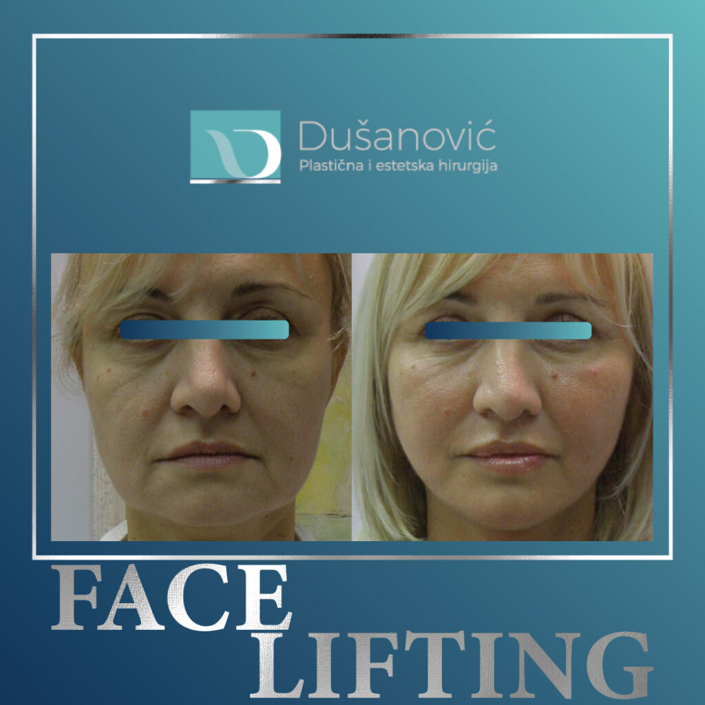face lifting, zatezanje lica