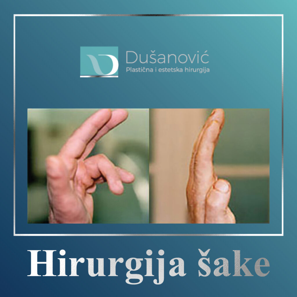 hirurgija sake